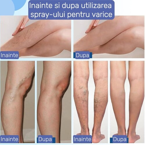 VenoRelief - alinare imediată pentru picioare